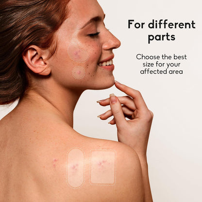 Large Acne Pimple Patches | 6 Sizes, 142 Counts, Hydrocolloid | Origin Zero
